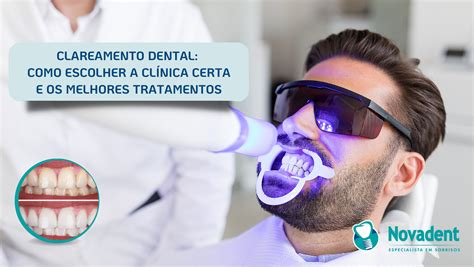 Quanto Custa Um Clareamento Dental Saiba Se Para Voc