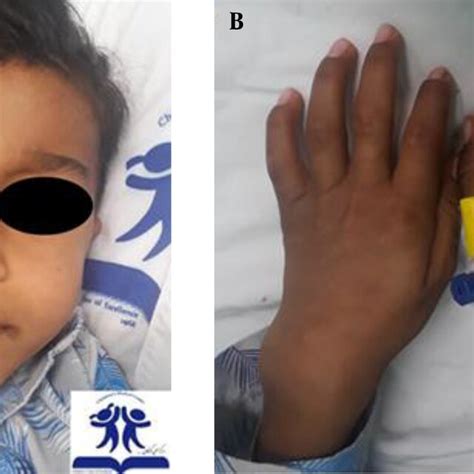 A, Face deformities include a long face with a prominent forehead and... | Download Scientific ...