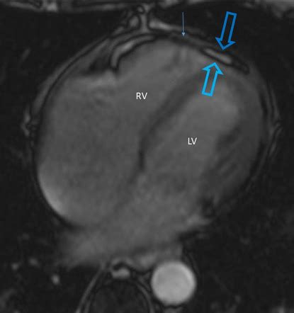 Constrictive Pericarditis Image Radiopaedia Org