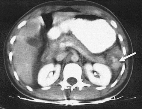 Pediatric Splenic Injuries With A Contrast Blush Successful