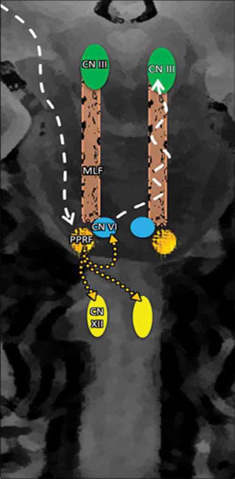 Surgical Neurology International