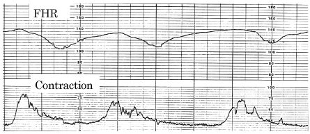 Late deceleration and hypoxia index in fetal monitoring