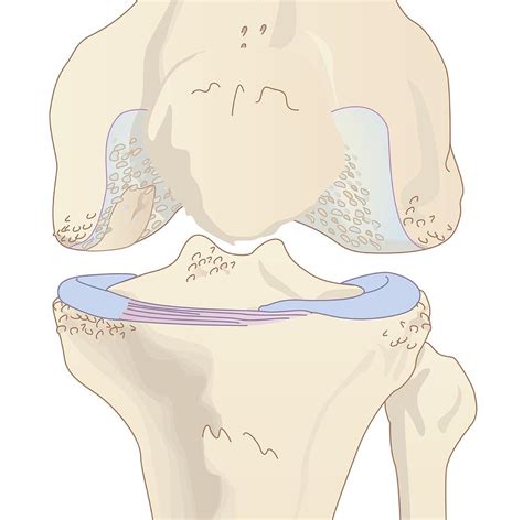 Osteoarthritis Of The Knee Artwork Photograph By Peter Gardiner Pixels