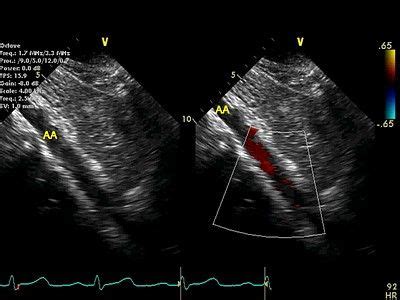 Subcostal Views (4 of 4) | Views, Abdominal aorta, Echo