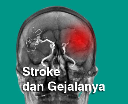stroke  gejalanya manggustore
