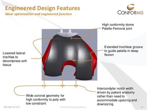 Conformis Patient Specific Custom Total Knee Replacement