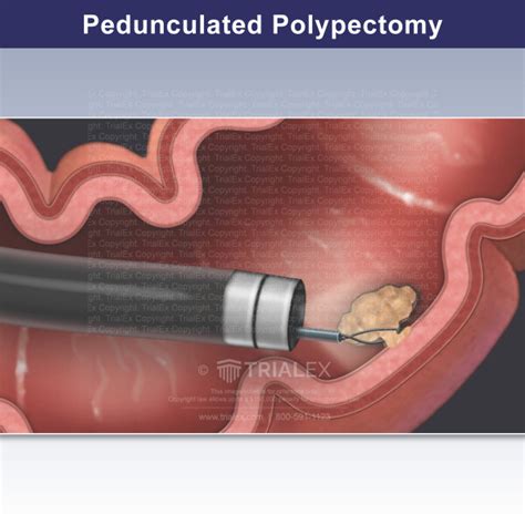 Endoscopic Retrograde Cholangiopancreatography ERCP Trial Exh