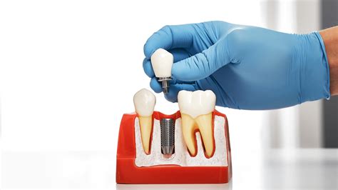 Are Dental Implants Safe Here S What You Need To Know