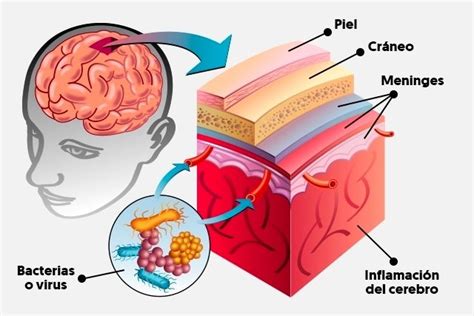 Meningitis qué es síntomas causas y tratamiento Tua Saúde