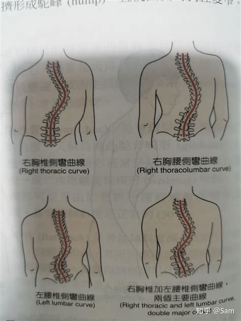 脊柱侧弯的评估与矫正 知乎