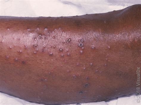 Chickenpox Or Hand Foot And Mouth Disease Differences And Images