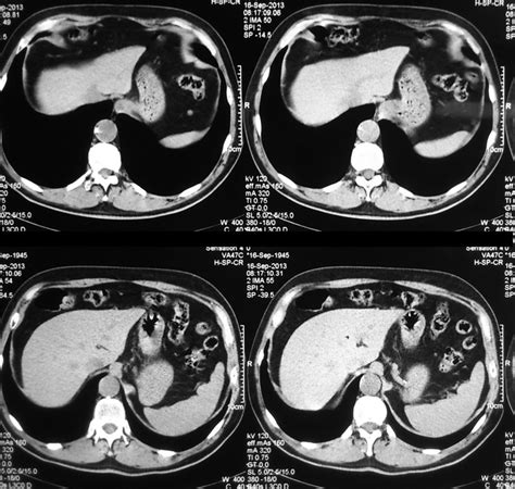 Ct Scan Of The Thorax And Abdomen With Contrast Material Showed Download Scientific Diagram