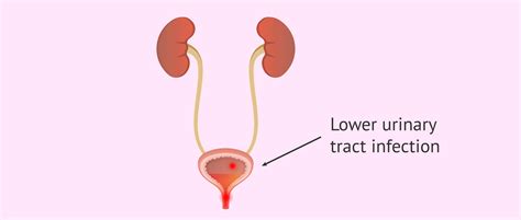 Where do lower urinary tract infections occur?