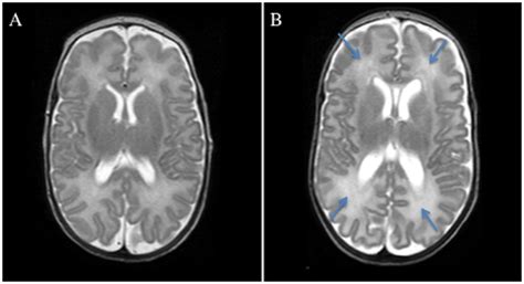 Axial T Weighted Mr Images Normal White And Gray Matter A And