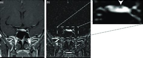 A 20-year-old woman with elevated levels of serum prolactin. (a) Early ...