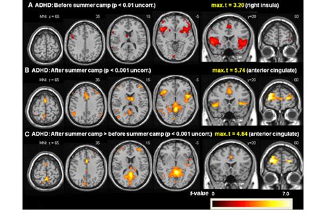 Adhd Brain Mri