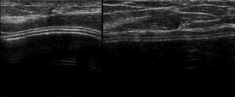 Transverse Ultrasound Image Of A Woman With Capsular Contracture The Download Scientific