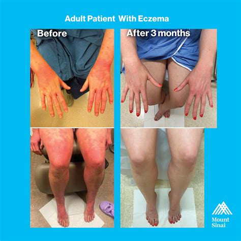 Mount - October is Eczema Awareness Month 🩷 a time to focus attention