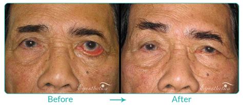 Ectropion After Lower Blepharoplasty