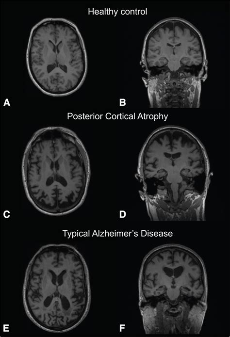 Neurodegenerative Features On T Mri Transverse A C E And Coronal