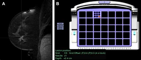 Mr Imagingguided Breast Interventions Magnetic Resonance Imaging Clinics