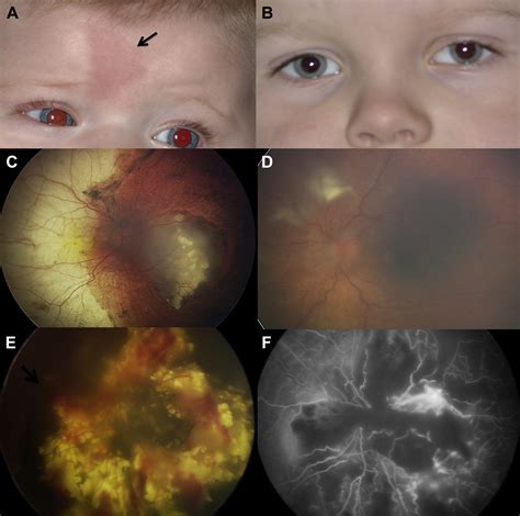 Intra Arterial Chemotherapy For Retinoblastoma In 70 Eyes Ophthalmology