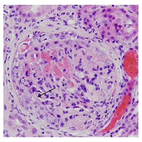 Kidney Biopsy A Glomerulus Showing Cellular Crescent Arrow With