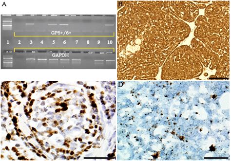 Human Papillomavirus HPV P16 Immunohistochemistry And HPV In Situ