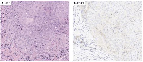 Hematoxylin And Eosin Stain Pd L1 Immunohistochemical Stain A Hande