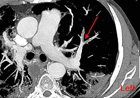 Pulmonary Computed Tomography Angiography Images Demonstrated Pulmonary