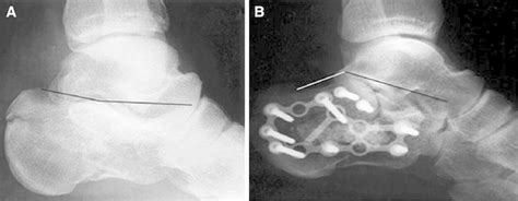 A Pre Op Loss Of Bohlers Angle In Displaced Intra Articular Calcaneal