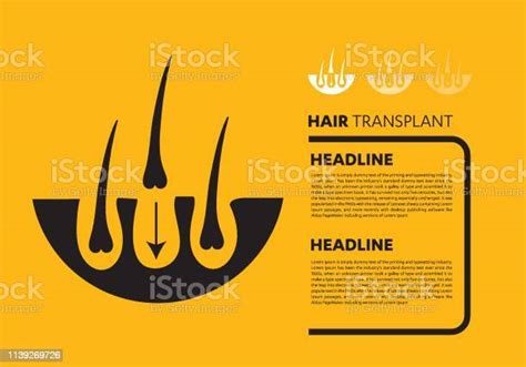 모발 이식 용 벡터 모 낭 성장 치료 뿌리 감각 지각에 대한 스톡 벡터 아트 및 기타 이미지 감각 지각 개념 과학