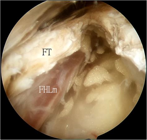 Endoscopic Release Of The Flexor Hallucis Longus Tendon At Posterior