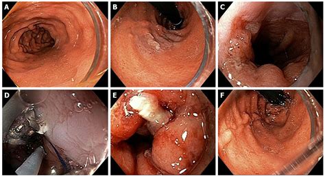 Stomach Acid Endoscopy Gerd Nusagates Free Nude Porn Photos