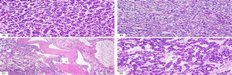 A Distinct Malignant Epithelioid Neoplasm With GLI1 Gene Rea The