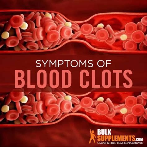 Blood Clots Symptoms, Causes and Treatment