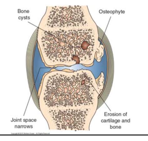 Connective Tissue Disorders Flashcards Quizlet