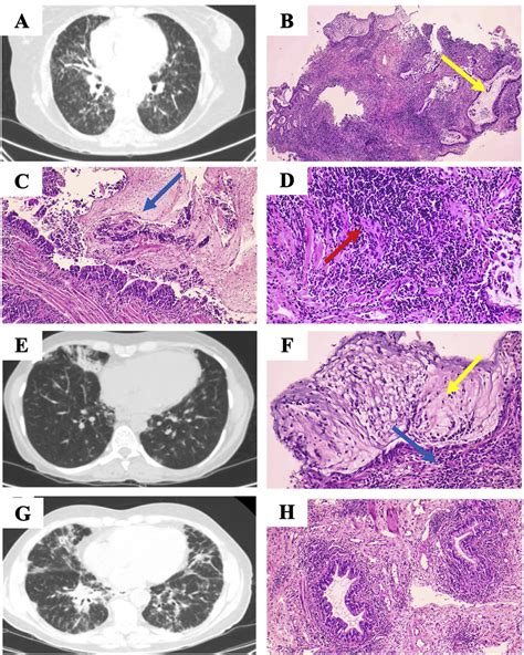 Granulomatous Lymphocytic Lung Interstitial Disease Glild A