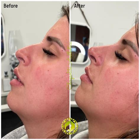 Non Surgical Rhinoplasty Houston Tx Chrysolite Aesthetics