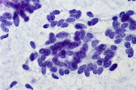 Carcinoid Tumor Fna Case 169 Contributed By Ed Uthman M Flickr