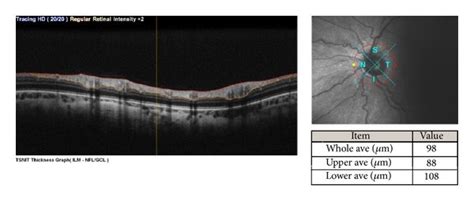 Optic Disc Measurements Were Within Normal Limits In The Right Eye A