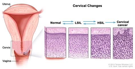 Understanding Cervical Changes A Health Guide For Women National