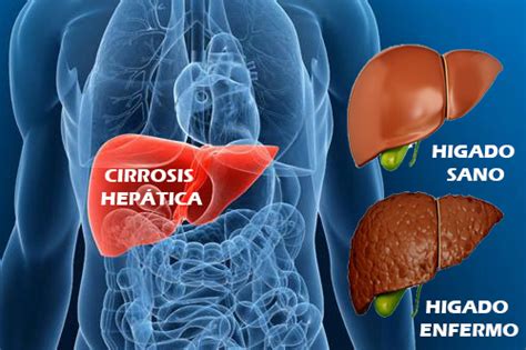 Sintomas De Cirrosis Hepatica En Sus Etapas Actualizado Diciembre