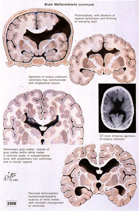 Neuropathology Blog Brain Malformations