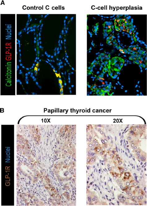 Glp 1 Receptors Glp 1r Are Expressed In Premalignant Lesions In Human