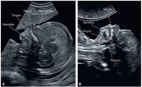 Fetal Face Ultrasound