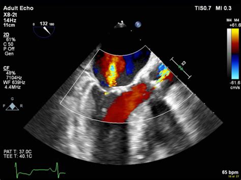 Echocardiography Tutorial - Echocardiographic Modes