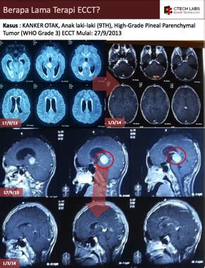 Tumor Treating Fields Ttf Electrical Cancer Therapy Saisei