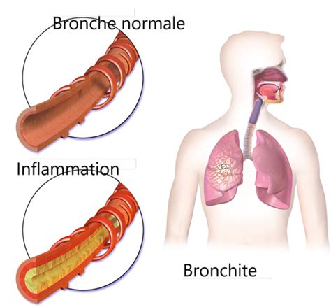 PNEUMOLOGIE Pathologies De L Appareil Respiratoire Cartes Quizlet