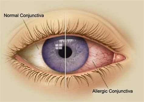 chronic allergic conjunctivitis - pictures, photos